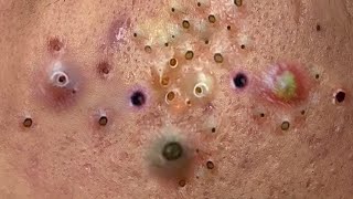 blackheads new 2023  popping pimple  acne and whiteheads removal [upl. by Eutnoj]