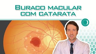 Posso operar buraco macular junto com catarata [upl. by Hewie838]