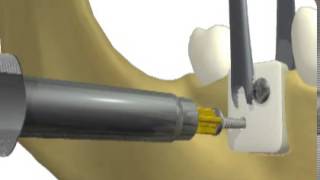 ACE truFIX Bone and Membrane Fixation System  Introduction [upl. by Mandal503]