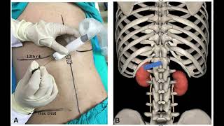 CELIAC PLEXUS BLOCK [upl. by Borries]