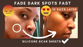 How to fade hyperpigmentation FAST with silicone SCAR SHEETS [upl. by Lundell207]