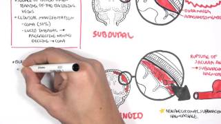 Intracranial Haemorrhage Types signs and symptoms [upl. by Tigdirb282]