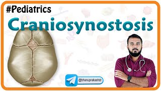 Craniosynostosis  Types Causes Diagnosis and Treatment  Pediatrics National exit test [upl. by Lasky785]