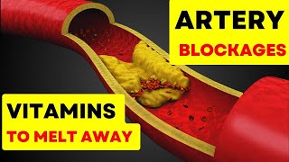 Remove Artery Plaque Top 6 Vitamins to Naturally Remove Plaque from Arteries  Boost Heart Health [upl. by Budding]