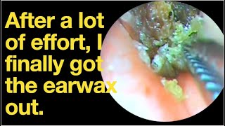 After a lot of effort I finally got the earwax outear wax removal  ear cleaning  ASMR  relax [upl. by Ymmit]