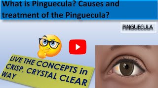 What is Pinguecula  What is the Causes of Pinguecula and the treatment of the Pinguecula [upl. by Anattar]