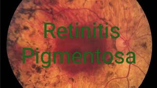 Retinitis pigmentosa RP treatment signs symptoms discussion  Simple version [upl. by Annekahs753]