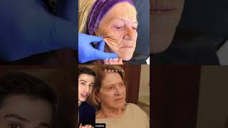 SHOCKING Chemical Peel Results dermreacts [upl. by Elgar]