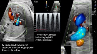 Step by Step analyses of a fetal echo case [upl. by Shields166]