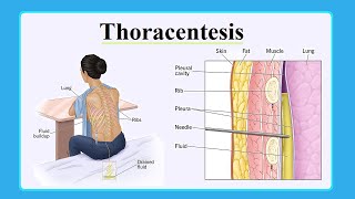 thoracentesis [upl. by Aissak]