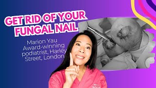 How to TREAT Fungal Nail  Get Rid Of Nail Fungus [upl. by Gregorio]