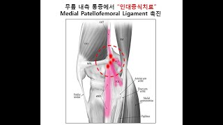 무릎의 내측부 통증에서 프롤로테라피인대증식치료 or Prolotheray 시 내측 슬개대퇴인대의 촉진Medial Patellofemoral Ligament Palpation [upl. by Yllod285]