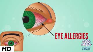 Eye Allergy Causes Signs and Symptoms Diagnosis and Treatment [upl. by Eckhardt489]