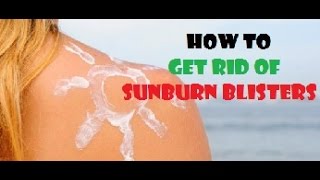 How to Get Rid of Sunburn Blisters Sunburn Treatment [upl. by Darcee110]