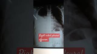 Pleural effusion  right [upl. by Adniral477]