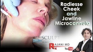 Radiesse Cheek and Jawline Microcannula with Dr Rajani at Style Aesthetics Portland Oregon [upl. by Eilegna]