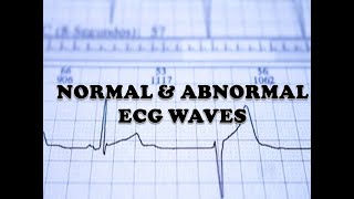 ECG INTERPRETATION  NORMAL WAVES AND ABNORMAL WAVES IN TAMIL  ABNORMAL ECG WAVE INDICATION [upl. by Gianni]