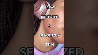 HOW TO TREAT IRRITATED AND SENSITIZED SKIN fast and easy‼️😅 [upl. by Munson]