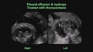 Pregnancy Intervention procedure [upl. by Primrosa]