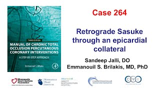 Case 264 Manual of CTO PCI Retrograde Sasuke through an epicardial collateral [upl. by Liek206]