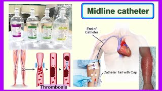 midline catheter [upl. by Cristian]