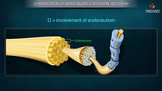 Classification of Peripheral Nerve Injury  Seddons classification  Sunderlands classification [upl. by Fidela]