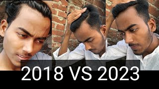 Then Vs Now After 5 Years  Big Forehead With Hairfall [upl. by Keele]