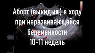 Самопроизвольный аборт в ходу при неразвивающейся беременности 1011 недель [upl. by Ataeb672]