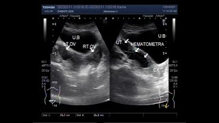 Hematometra in 25 years old unmarried lady [upl. by Bobker]