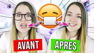 AVOIR UN APPAREIL DENTAIRE  AVANT VS APRES [upl. by Devina]