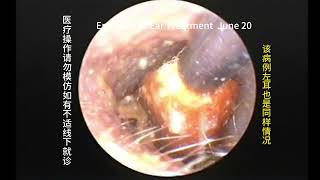 Regular followup and cleaning of external auditory canal cholesteatoma [upl. by Alledi]