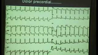 Curso ECG 2010  01 Fibrilación Ventricular [upl. by Romola]