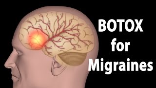 BOTOX for Migraines Animation [upl. by Bigelow]