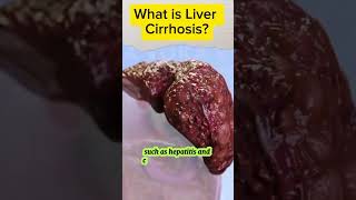 Liver Cirrhosis What You Need to Know livercirrhosis liverhealth acnnlifearena shortvideo [upl. by Yenots]