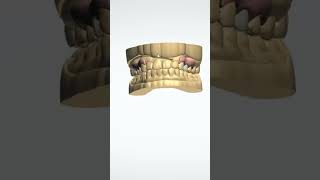 Upper Flexible Denture smile [upl. by Hachmann165]