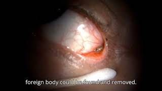 Bug in Conjunctiva  Conjunctiva Foreign Body [upl. by Carl]