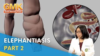 Elephantiasis Symptoms Causes and Treatment Part 2  Usapang Pangkalusugan [upl. by Ollie526]