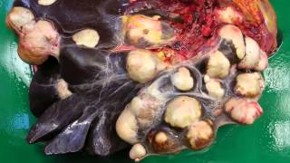 Hydatid cyst liver cyst due to Echinococcus infection [upl. by Celin]