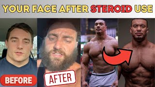 How you look AFTER steroids What steroids does to your face [upl. by Nylarad]