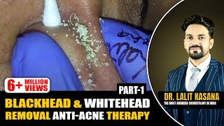 BLACKHEAD amp WHITEHEAD REMOVAL ANTIACNE THERAPY PART  1 [upl. by Garwin]