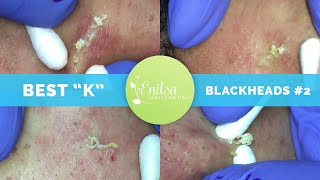 quotKsquot Best Blackhead Extraction Compilation Part 2 [upl. by Arahs]