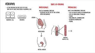 Cellular Adaptation  hyperplasia hypertrophy atrophy and metaplasia  cell injury [upl. by Memberg698]