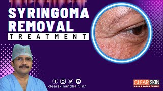 How To Treat Syringomas  Syringomas Removal Treatment  Clear Skin Hair and Laser Centre kurnool [upl. by Sitoeht]