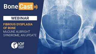 Fibrous dysplasia of bone McCune Albright syndrome an update [upl. by Cilo930]