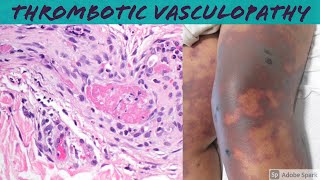 Thrombotic Vasculopathy amp Cryoglobulinemia 5Minute Pathology Pearls [upl. by Hamfurd]