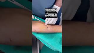 Removal of 33 Lipomas  Lipoma Removal Surgery  Dr Vijay Langer shorts shortsfeed [upl. by Hepzi305]