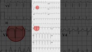 AVNRT ECG Example [upl. by Etnovad]