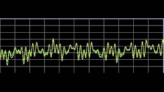 Autism Autistic DisordersRife Frequencies [upl. by Griggs]