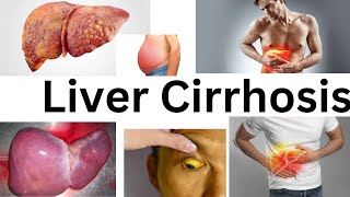 Liver CirrhosisAmharic Tutorial [upl. by Attiuqram]