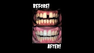 25 Years of BRACES in 40 seconds BEFORE AND AFTER Closing Large Teeth Gap🦷Shorts braces [upl. by Nonrev383]